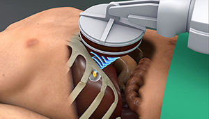 focused ultrasound liver tumors cancer